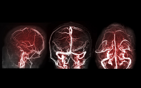 MRV 脑或脑磁共振静脉造影检查脑静脉引流异常