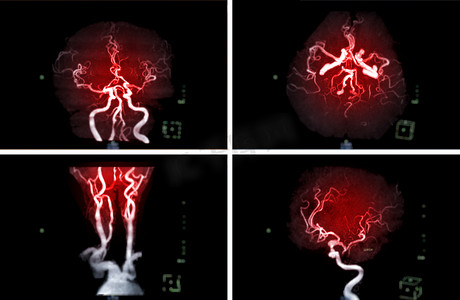 比较脑动脉和颈总动脉的 MRA 脑或磁共振血管造影 (MRA) 的 AP 和侧视图，以评估它们的狭窄和中风疾病。