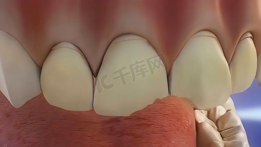 碎裂受损牙齿的过程
