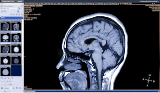 MRI 大脑矢状 T1 视图，用于检测屏幕上孤立的各种大脑状况，例如囊肿、肿瘤、出血。