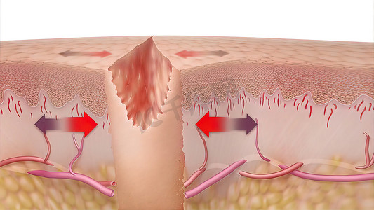 动脉摄影照片_皮肤伤口愈合时间的 3D 医学插图