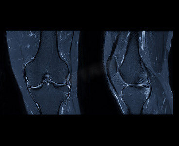 冠状摄影照片_膝关节 MRI 或膝关节磁共振成像搅拌技术的轴向、矢状和冠状视图对脂肪抑制的比较。