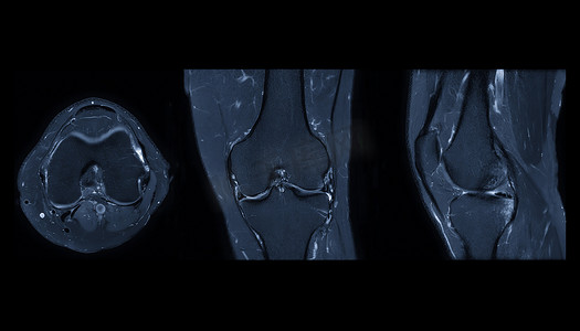 抑制摄影照片_膝关节 MRI 或膝关节磁共振成像搅拌技术的轴向、矢状和冠状视图对脂肪抑制的比较。