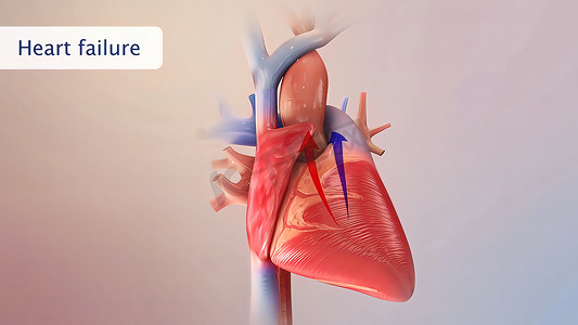 心力衰竭意味着心脏无法正常地将血液泵送到全身各处。