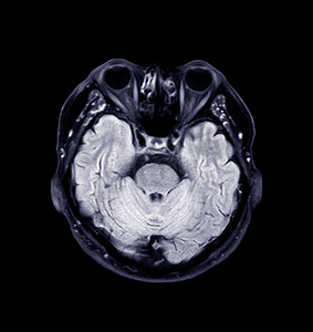 矢矢摄影照片_大脑 MRI 轴向 T2 天赋