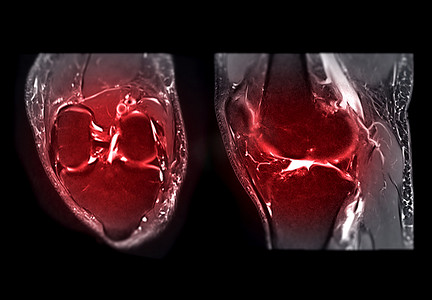 抑制摄影照片_MRI 膝盖 T2W 脂肪抑制。