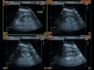 超声上腹部显示肝脏、胆囊和肾脏，用于筛查腹部疾病。
