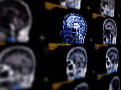 MRI 大脑矢状面的选择性焦点用于检测大脑的各种状况，如囊肿、肿瘤、出血、肿胀、发育和结构异常或感染。