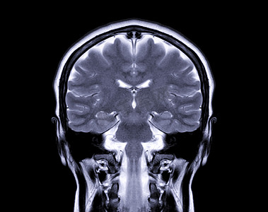 肿瘤检查摄影照片_MRI 脑冠状 t2W 视图用于检测大脑的各种状况，例如屏幕上孤立的囊肿、肿瘤、出血。