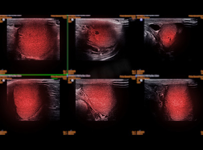 减退摄影照片_甲状腺超声检查用于甲状腺诊断。