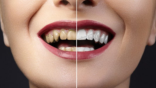 面膜美白素材摄影照片_牙齿美白治疗或牙贴面前后。