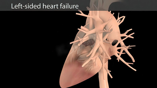 跳动摄影照片_3D 动画右心衰竭 - 跳动的心脏