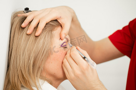整形手术前面部的眼睑标记特写，用于在医疗诊所修改面部眼部区域。