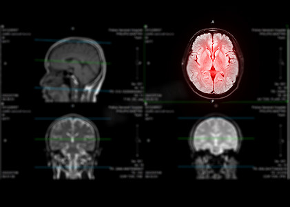 MRI 脑轴天赋用于检测中风疾病以及脑肿瘤和囊肿。