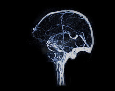引流活动摄影照片_MRV 大脑或大脑磁共振静脉造影检查大脑矢状面静脉引流异常。