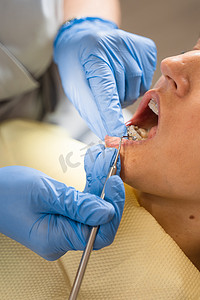 牙齿矫正牙套口腔医学程序。