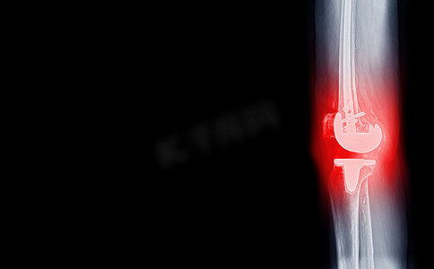 人工关节摄影照片_骨关节炎膝关节患者和膝关节置换人工关节的 X 射线胶片侧视图。