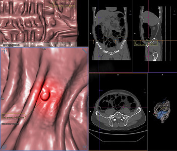 CT 结肠成像或结肠轴向视图与冠状视图和 3D 渲染图像的 CT 扫描