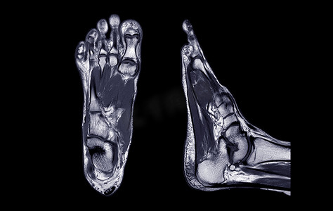 足部磁力共振成像或 MRI FOOT PDW 轴向、冠状和矢状视图，用于诊断肌腱损伤。