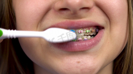戴牙套的女孩用牙刷特写刷牙。