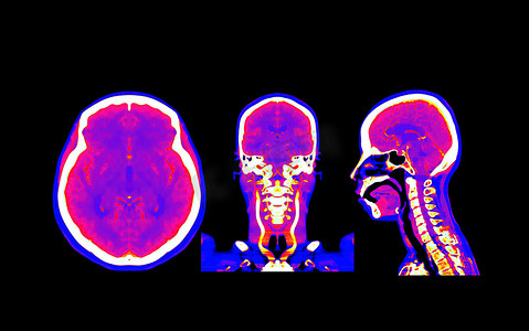 收集彩色脑 CT 血管造影或 CTA 脑比较轴向、冠状和矢状视图。