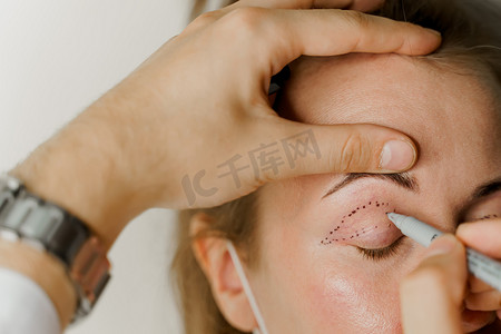 在医疗诊所进行整形手术之前，对面部进行眼睑成形术标记特写，以修改面部的眼部区域。 