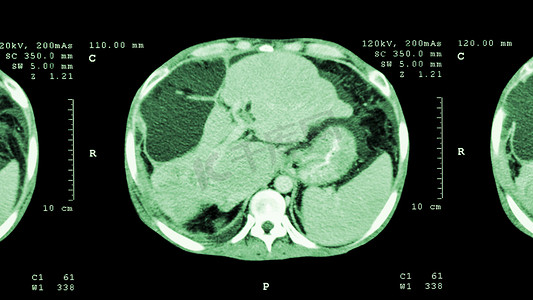 肝胆相照摄影照片_上腹部CT扫描：显示肝脏异常肿块（肝癌）