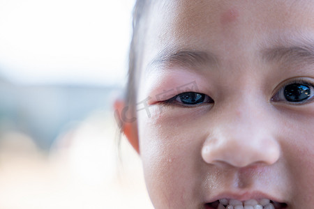 闭合的亚洲孩子小女孩眼睛与麦粒肿