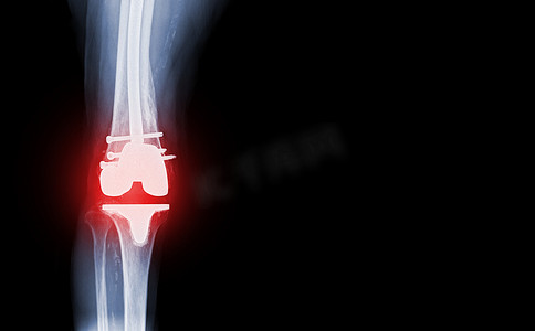 骨关节炎膝关节患者和人工关节置换膝关节的胶片 X 射线膝关节 AP 视图。