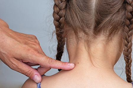 成人手指在儿童颈背上显示胎记
