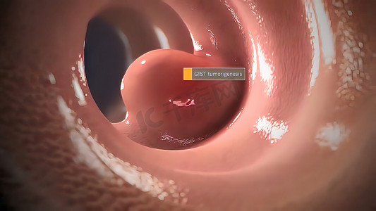 胃肠道间质瘤是胃肠道中一种罕见的癌症。