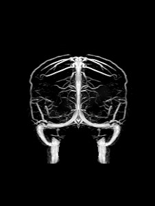 血型摄影照片_MRA 大脑和 MRV 大脑。