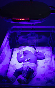 紫外线灯下的新生婴儿。