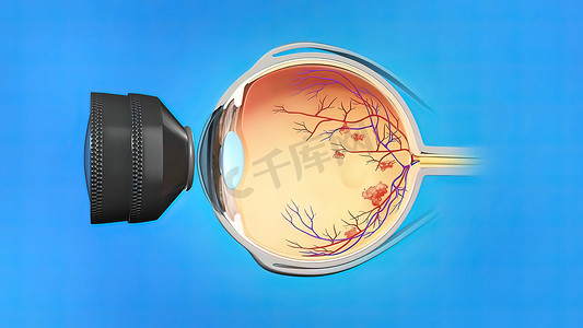 激光手术、眼部激光治疗