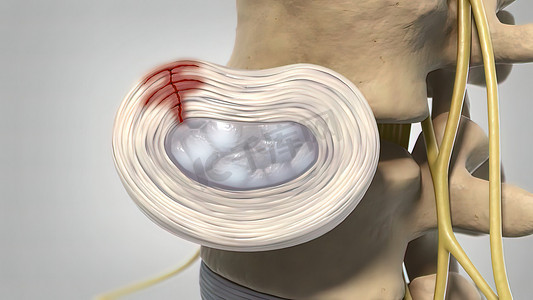 退行性椎间盘疾病 3d 医疗