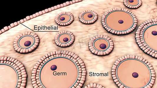 间质摄影照片_生殖细胞-性腺间质-卵巢上皮肿瘤的组合。