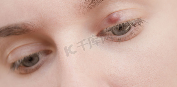 弹弓造型摄影照片_因麦粒肿感染引起的上眼睑疼痛发红。