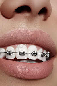 戴牙套摄影照片_戴着牙套的美丽洁白的牙齿。