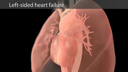 3D 动画右心衰竭 - 跳动的心脏