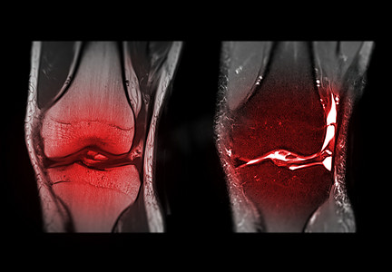 MRI 膝关节冠状视图