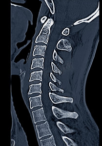 spine摄影照片_CT C-Spine 或颈椎 3D 渲染图像与矢状面的比较