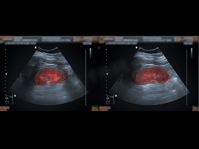 超声波上腹部显示肾脏，用于筛查肾脏疾病。