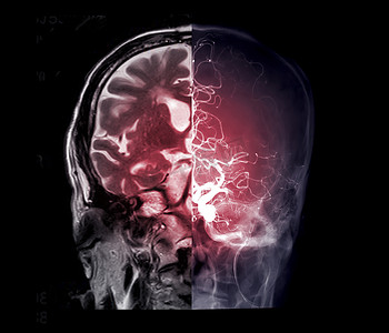 比较 MRI 脑冠状视图 脑血管造影图像前视图显示脑动脉的位置。