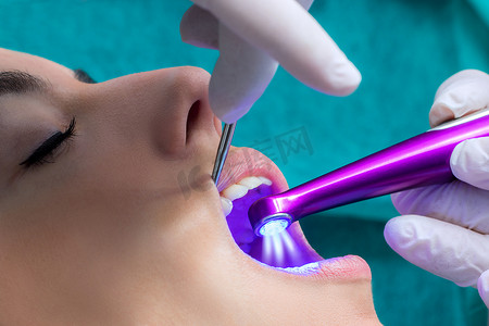 牙医用 LED 固化灯给患者设置窝沟封闭剂。