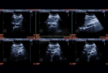 超声波上腹部显示肝脏、肾脏、胰腺和胆囊，用于检测 HCC 或胆结石。