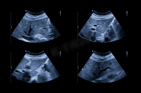 回波摄影照片_上腹部超声显示肝脏和胆囊，用于筛查肝细胞癌和胆结石。