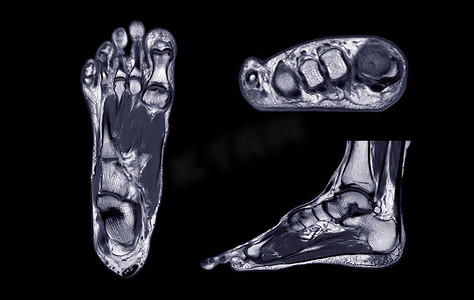 足部磁力共振成像或 MRI FOOT PDW 轴向、冠状和矢状视图，用于诊断肌腱损伤。