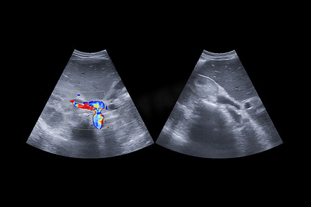 上腹部超声显示肝胆系统以及肝脏和胆囊的解剖结构，用于筛查肝癌的肝细胞癌。