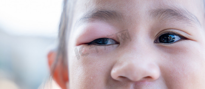 闭合的亚洲孩子小女孩眼睛与麦粒肿