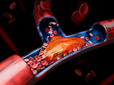 深静脉血栓或血凝块的 3d 插图。